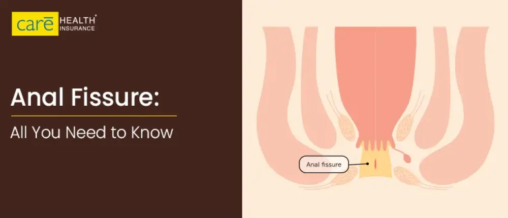 Anal Fissure: Symptoms, Causes, Risks and Treatment