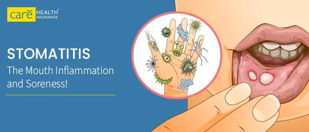What is Stomatitis? Its Types, Causes and Treatment!
