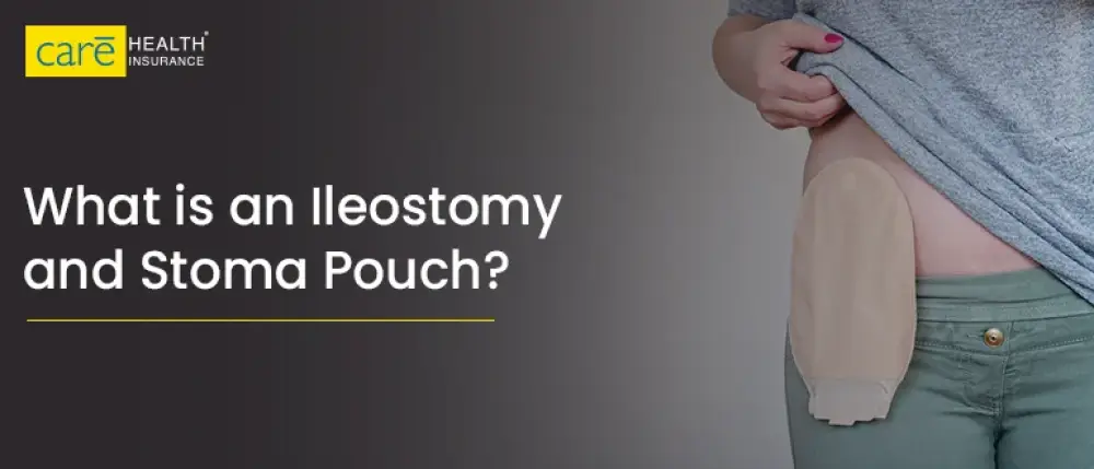 Ileostomy Meaning: Types, Risk Factors & Tips to Manage