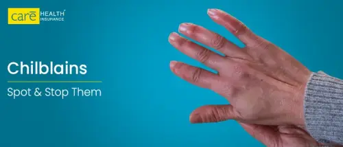 What are Chilblains and How Can You Treat Them?