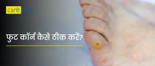 पैरों में कॉर्न क्या होता है? जानें कारण, लक्षण और घरेलू उपचार