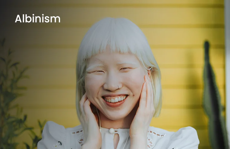 Albinism Albinism