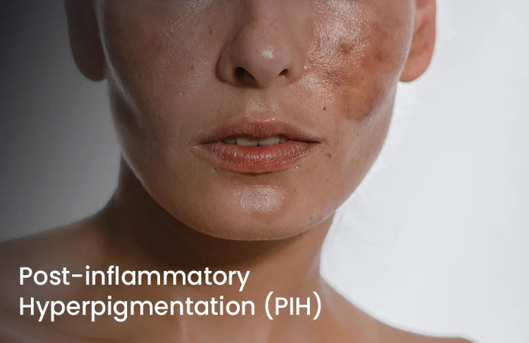 Hyperpigmentation Hyperpigmentation