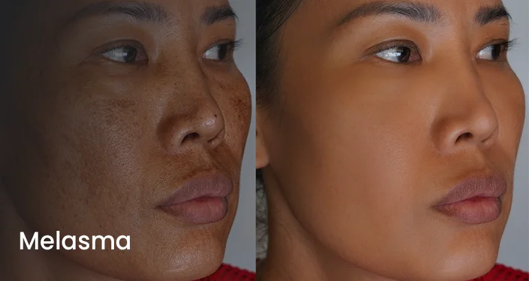 Melasma Melasma