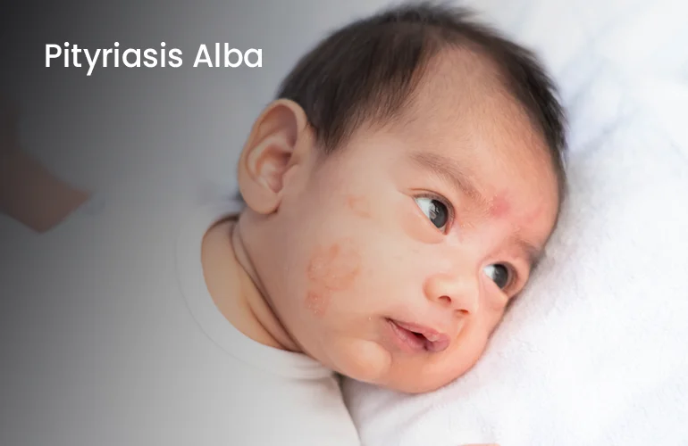 Pityriasis Pityriasis