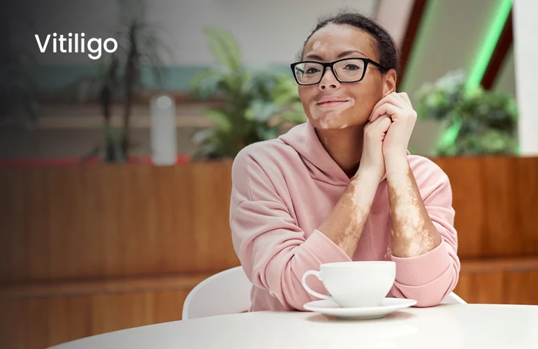 Vitiligo Vitiligo