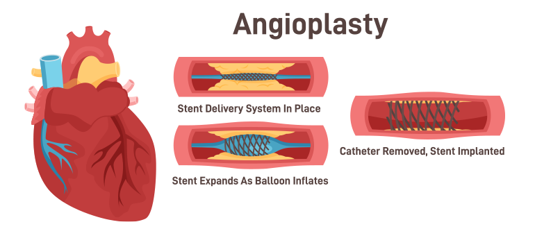 what is angioplasty