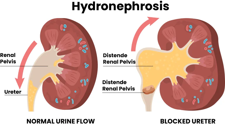 Common Causes of Hydronephrosis