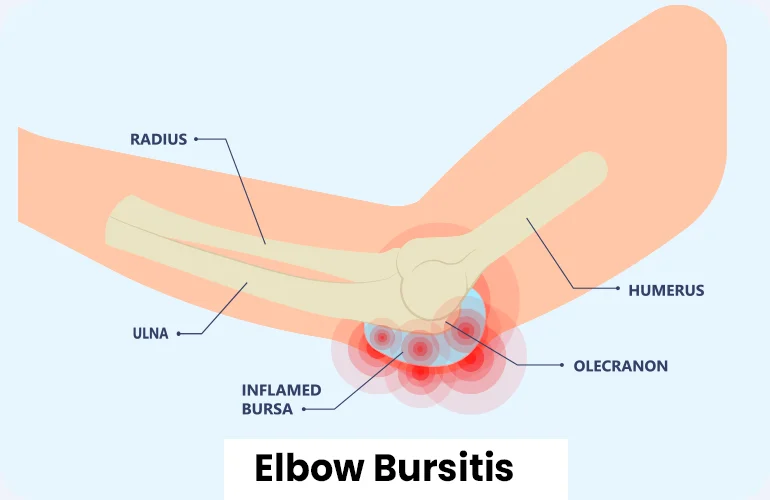 elbow bursitis