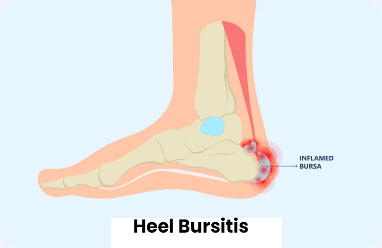 heel bursitis