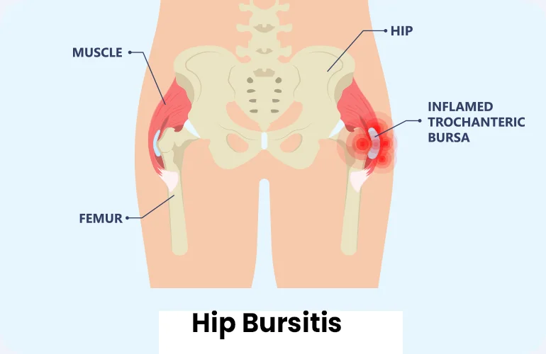 hip bursitis