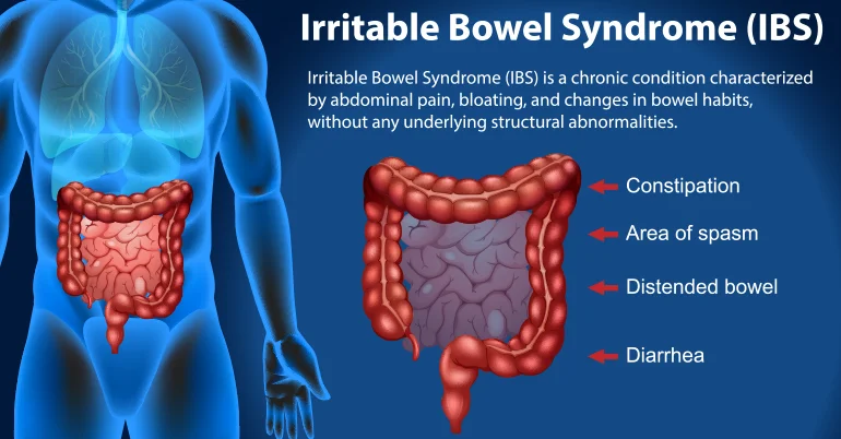 Irritable Bowel Syndrome