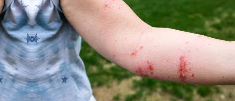 Plants-related Allergies