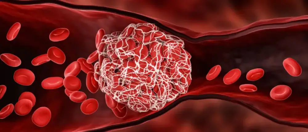 blood clots know the causes risks symptoms and treatment