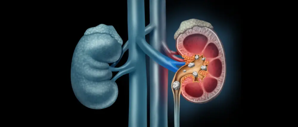 Discover the Top Causes of Kidney Stones and How to Prevent Them