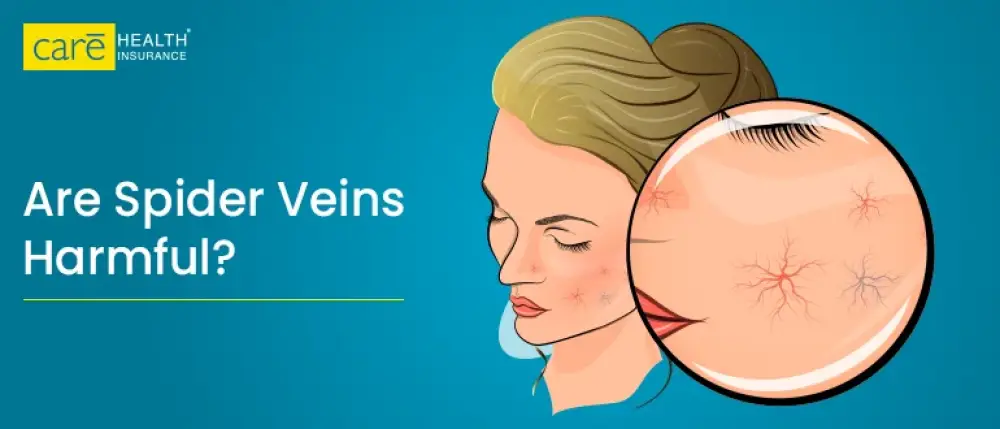 You Might Be Overlooking Spider Veins in These 5 Body Areas