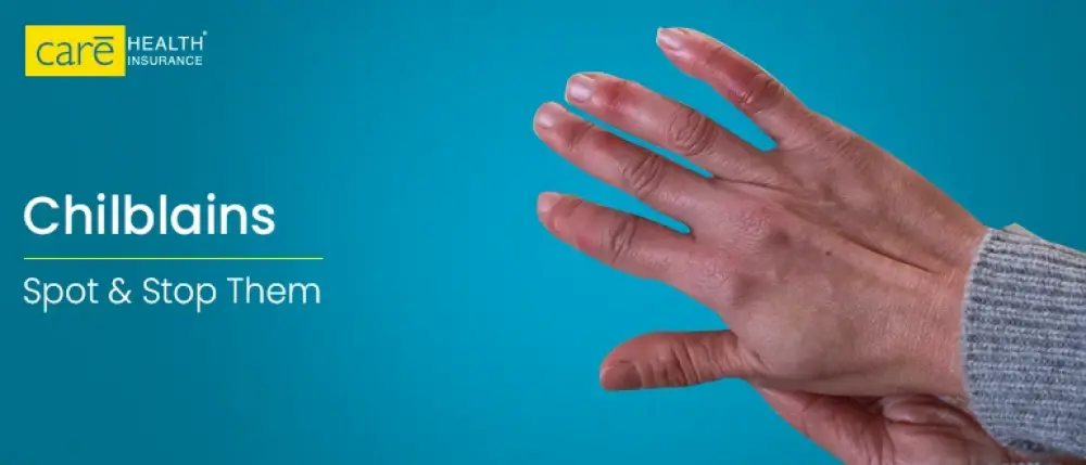 What are Chilblains and How Can You Treat Them?