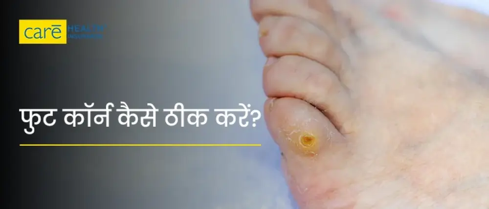 पैरों में कॉर्न क्या होता है? जानें कारण, लक्षण और घरेलू उपचार पैरों में कॉर्न क्या होता है? जानें कारण, लक्षण और घरेलू उपचार