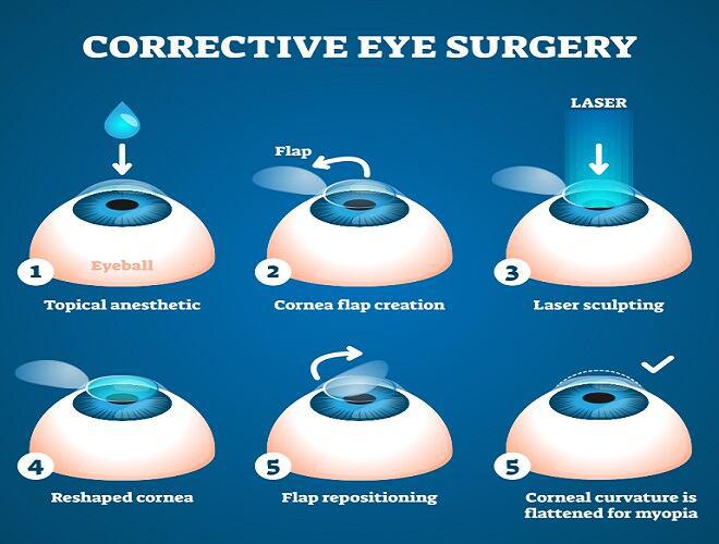 eye surgery procedure