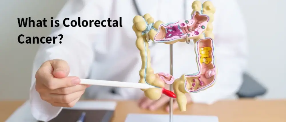 Colorectal Cancer: Types, Causes, Symptoms And Treatment