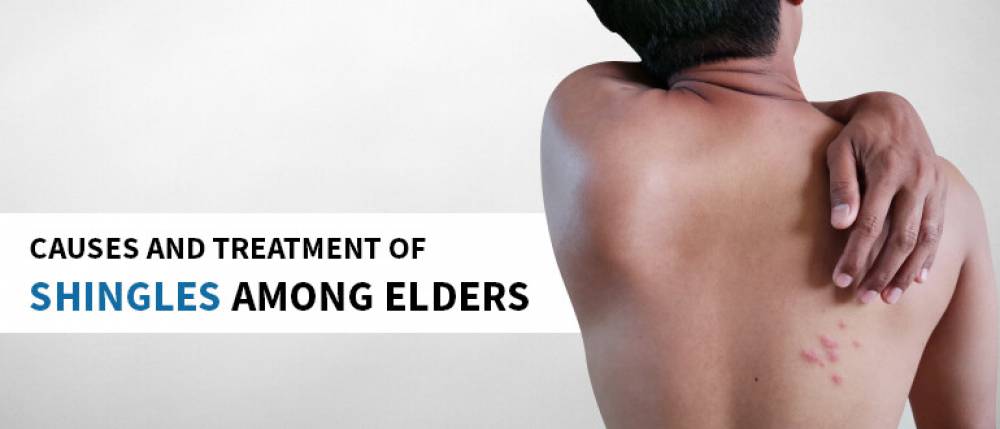 causes and treatment of shingles among elders in india