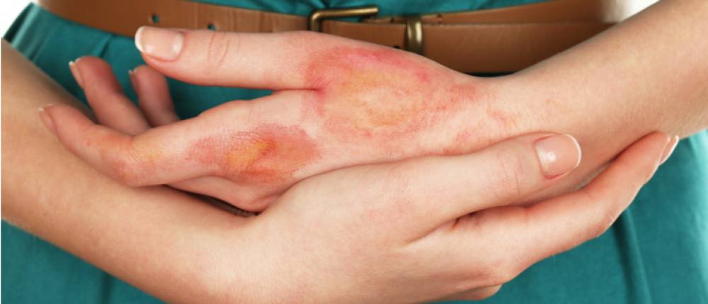 Does Your Health Insurance Cover Skin Burns?