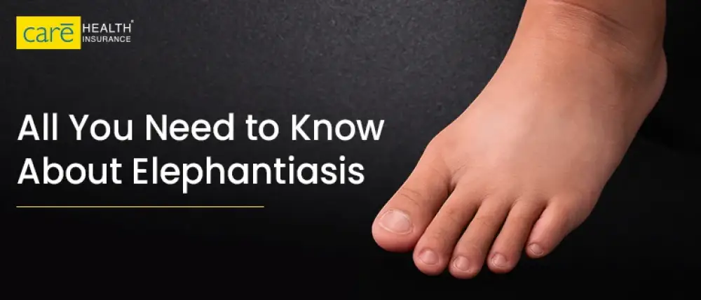 Addressing the ‘Parasite’ in the Room: A Guide to Elephantiasis