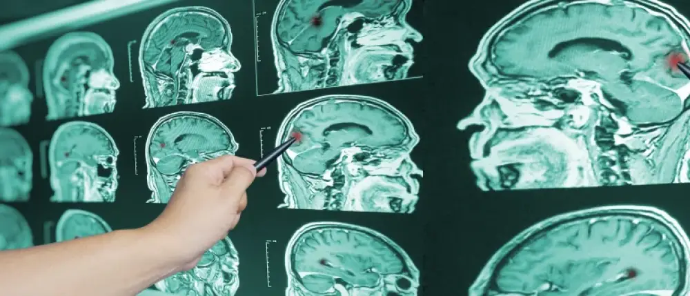 Brain Hemorrhage: Causes, Symptoms and Treatment