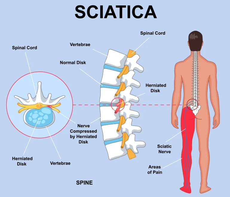 Sciatica Sciatica