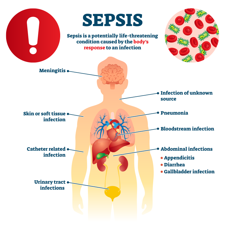 sepsis infection causes