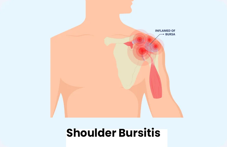shoulder bursitis