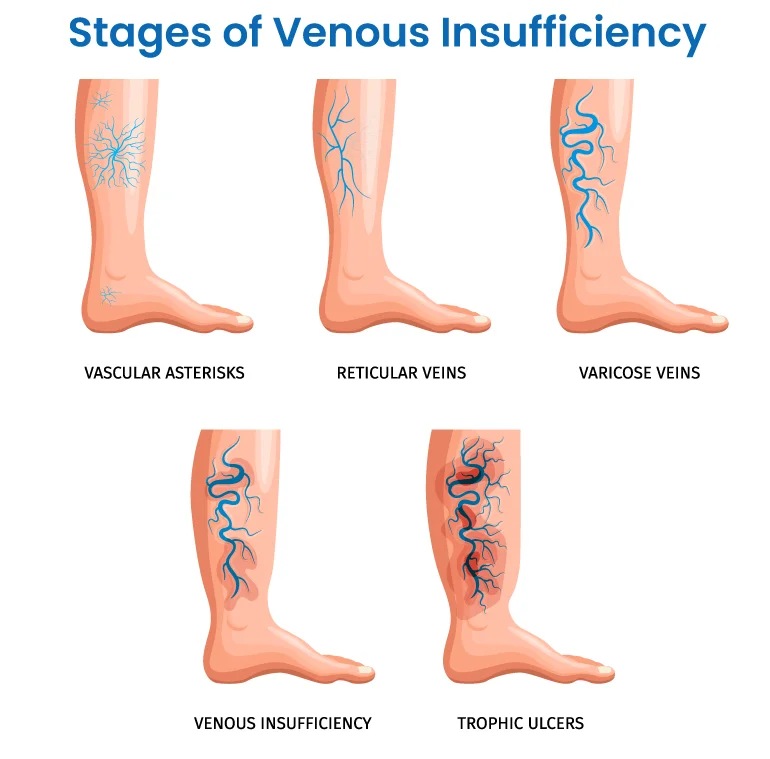 Stages of Chronic Venous Insufficiency Stages of Chronic Venous Insufficiency