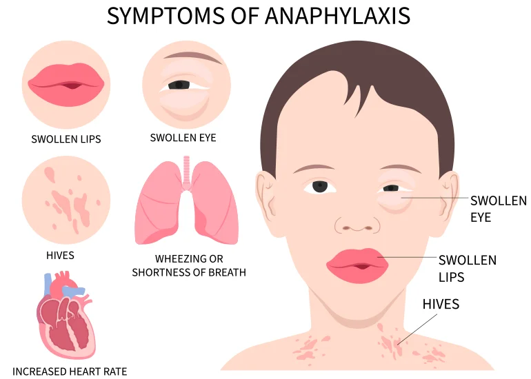 symptoms of anaphylaxis symptoms of anaphylaxis