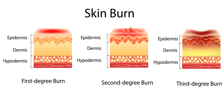 types of skin burn