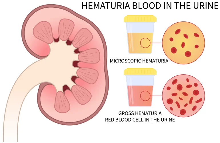 Uremia vs Uremic Syndrome Uremia vs Uremic Syndrome