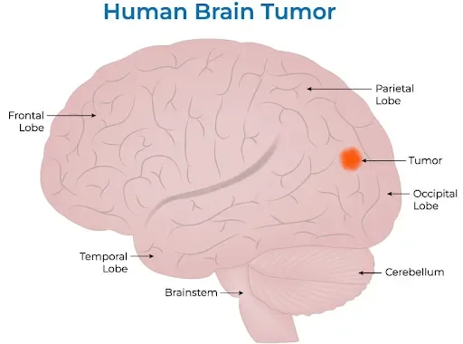What is a Brain Tumour