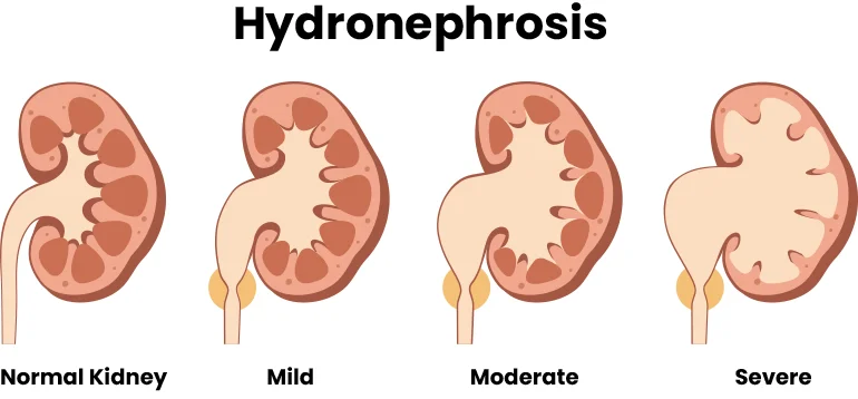 What is Hydronephrosis?