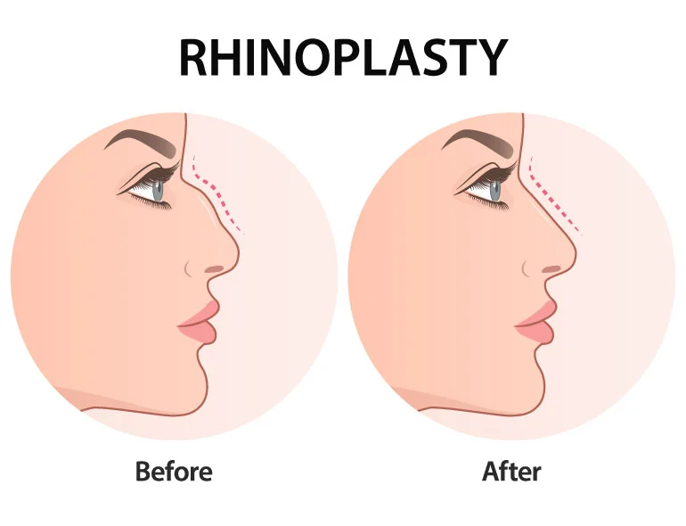 What is Rhinoplasty